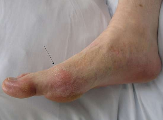 A foot infected with gout.